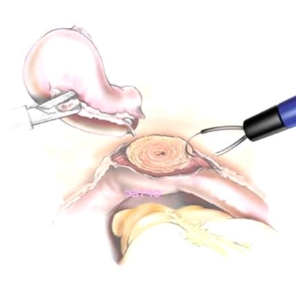 Laparoscopic Electrode 1