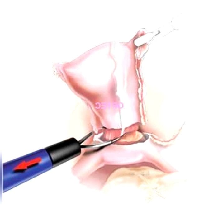 Laparoscopic Electrode