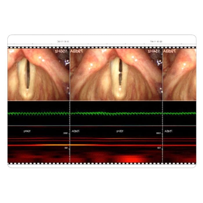 Laryngoscopic Column 6