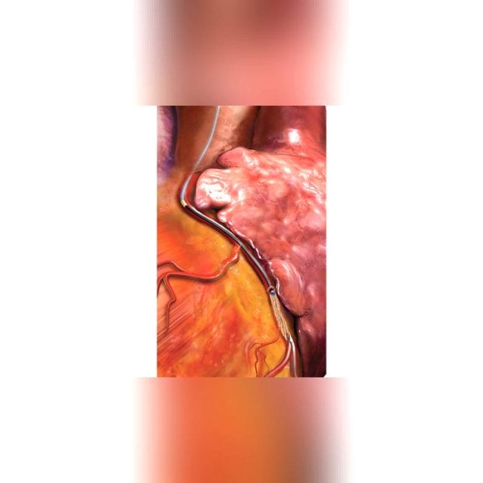 Laser Atherectomy Catheter 2