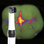 Laser Fluorescence Caries Detector