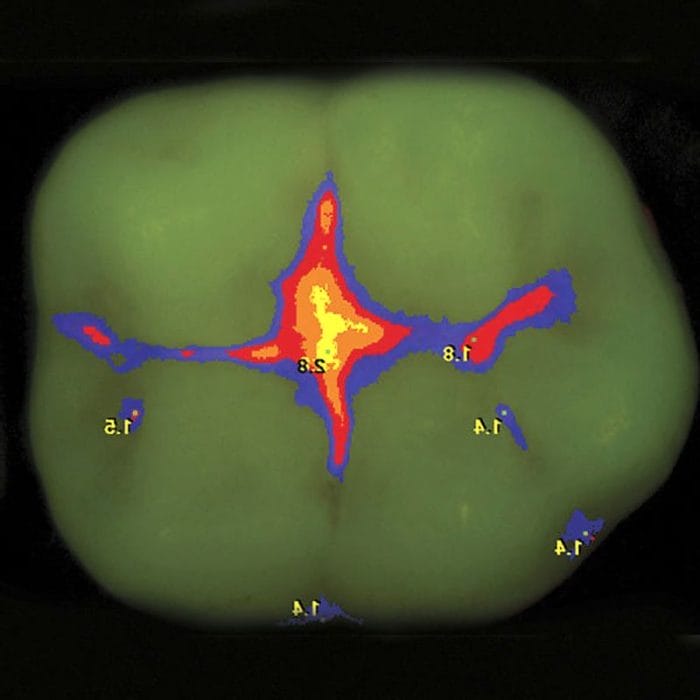 Laser Fluorescence Caries Detector 8