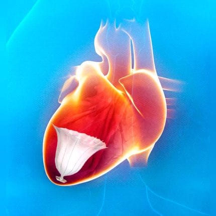 Left Ventricle Cardiac Restoration System 1