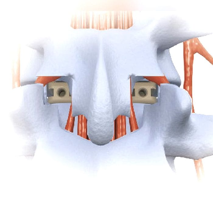 Lumbar Interbody Fusion Cage 2