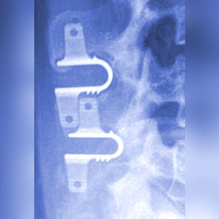 Lumbar Interspinous Vertebral Implant 2