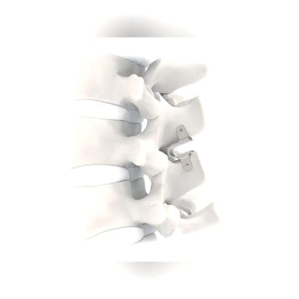 Lumbar Interspinous Vertebral Implant 1