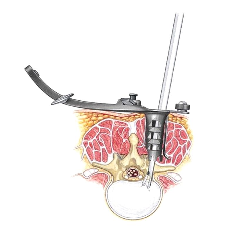 Lumbar Retractor 1