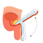 Malleable Penile Prosthesis 1