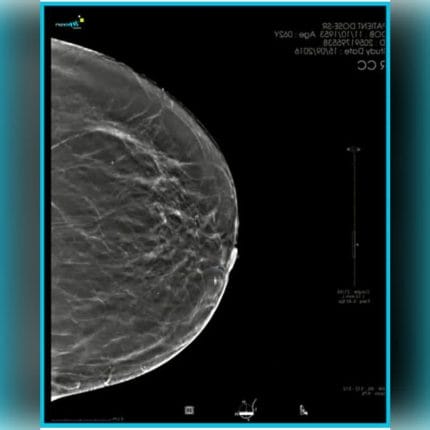 Mammography Software Module