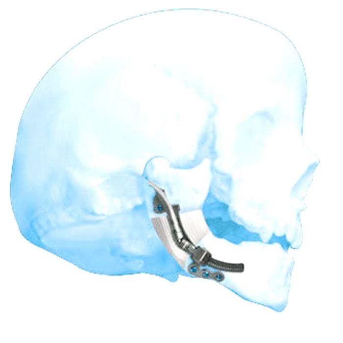 Mandibular Distractor 1