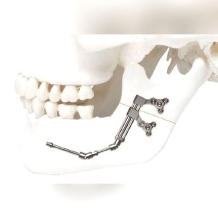 Mandibular Distractor 1