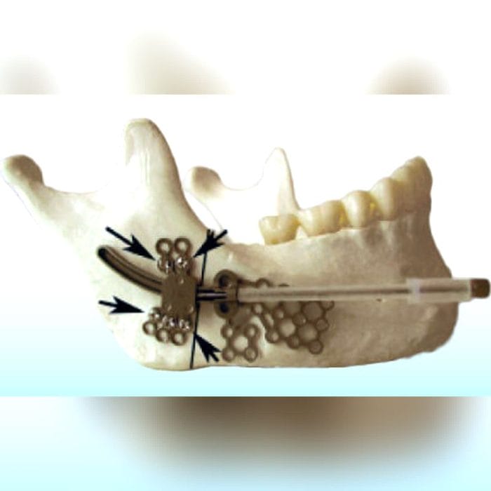 Mandibular Distractor 3