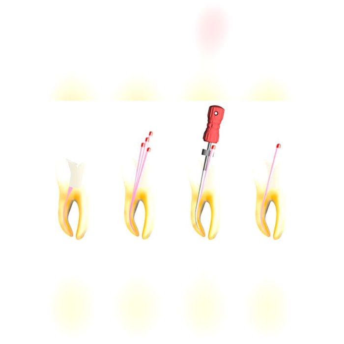 Manual Root Canal Obturator 3