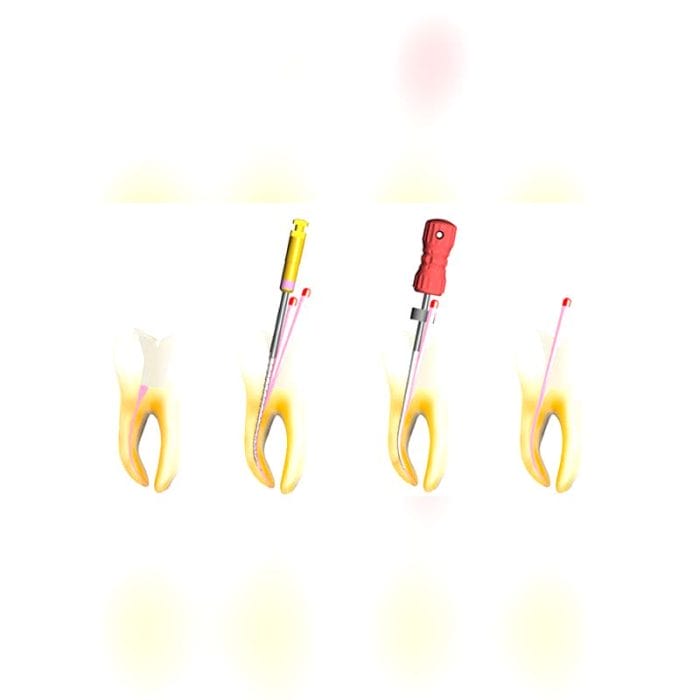 Manual Root Canal Obturator 4