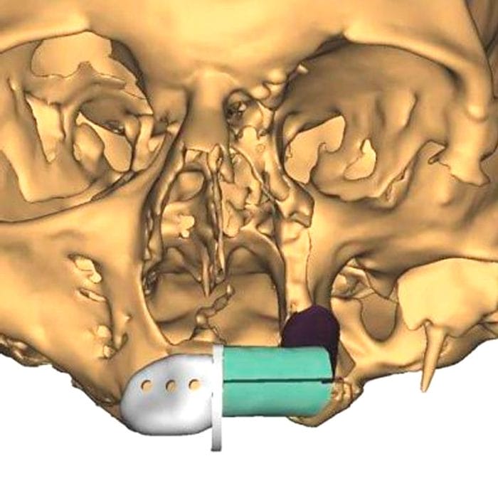 Maxillofacial Reconstruction Resection Guide 2