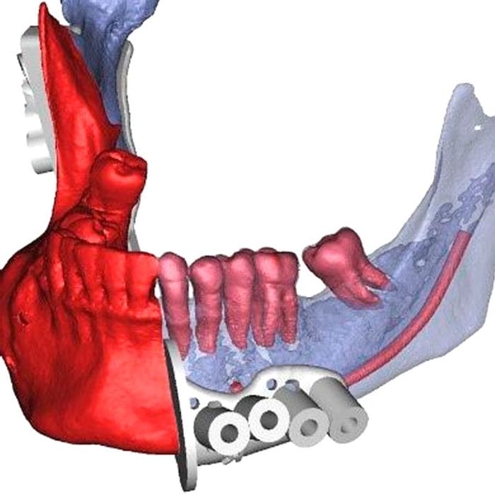 Maxillofacial Reconstruction Resection Guide 3