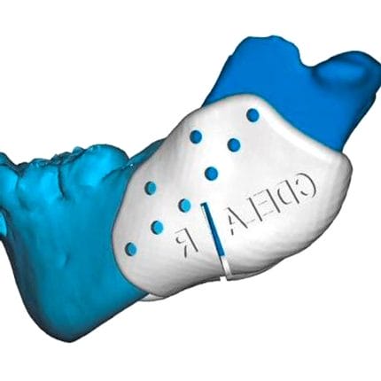 Maxillofacial Reconstruction Resection Guide