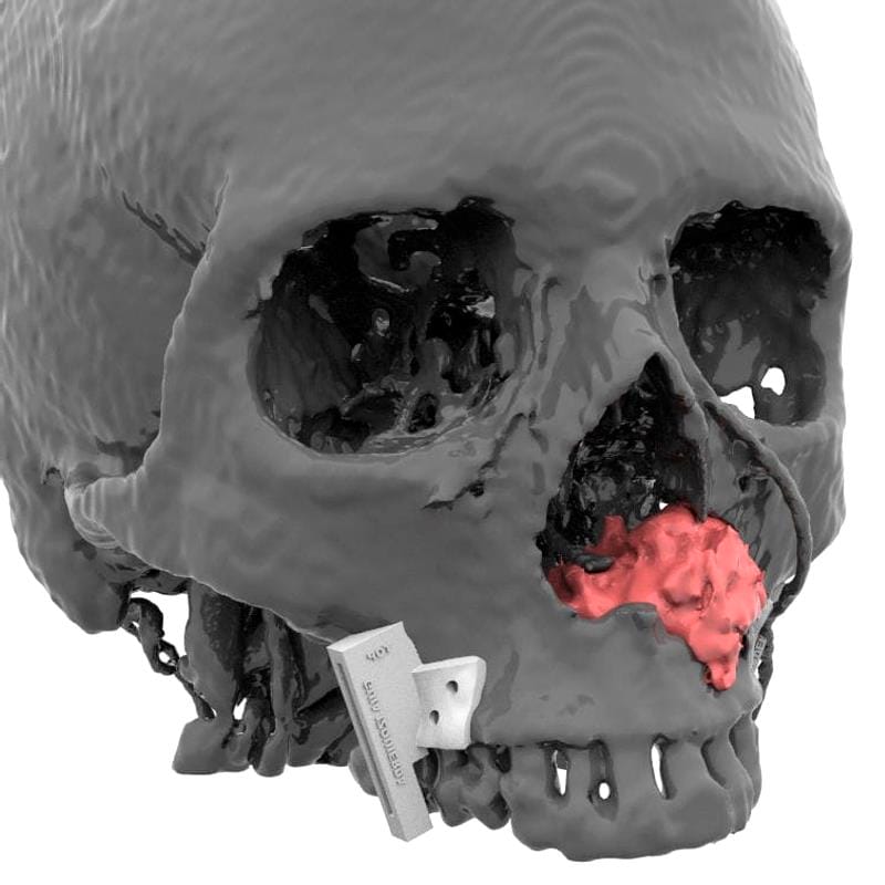 Maxillofacial Reconstruction Resection Guide