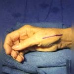 Metacarpophalangeal Joint Implant 1