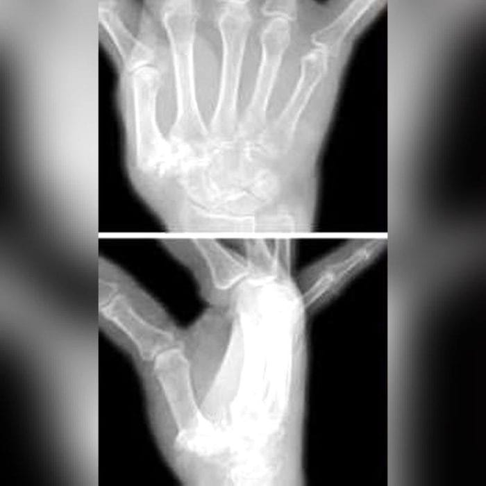 Metacarpophalangeal Joint Implant 2