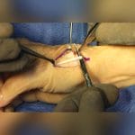 Metacarpophalangeal Joint Implant 3