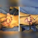 Metacarpophalangeal Joint Implant 4