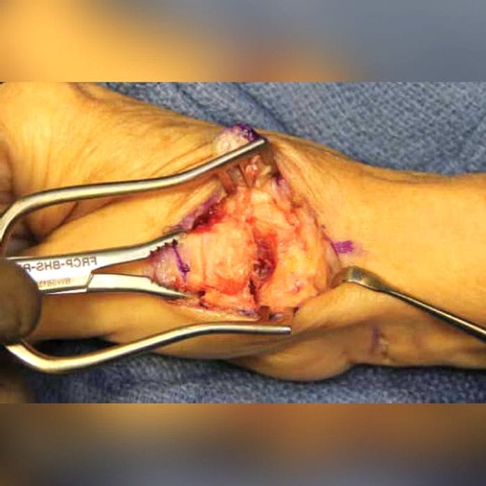 Metacarpophalangeal Joint Implant 5