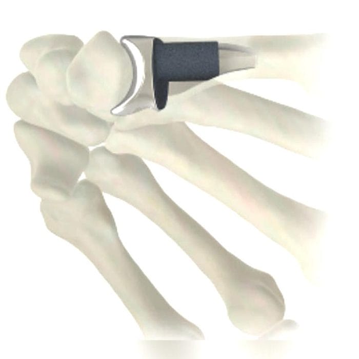 Metacarpophalangeal Joint Implant