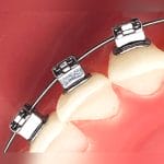 Metal Orthodontic Bracket 2