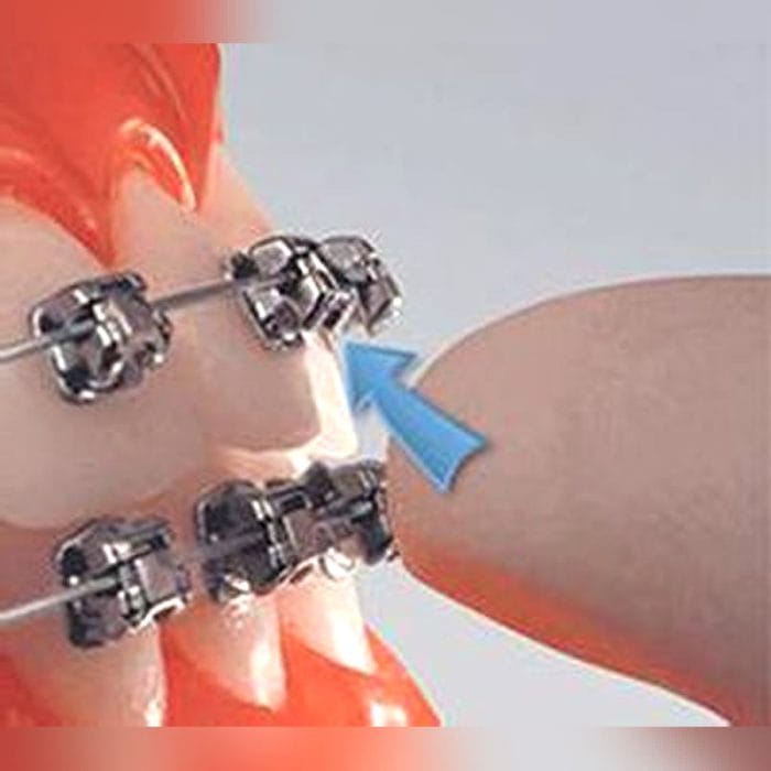 Metal Orthodontic Bracket 5