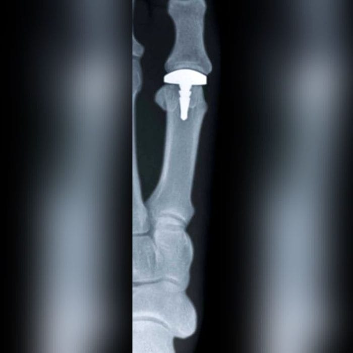 Metatarsophalangeal Joint Implant 5