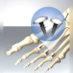 Metatarsophalangeal Joint Implant 6