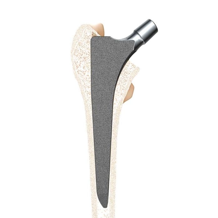 Minimally Invasive Femoral Stem 5