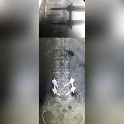 Minimally Invasive Pedicle Screw Positioning System 1