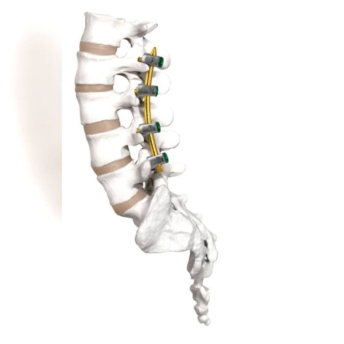 Minimally Invasive Pedicle Screw Positioning System 3