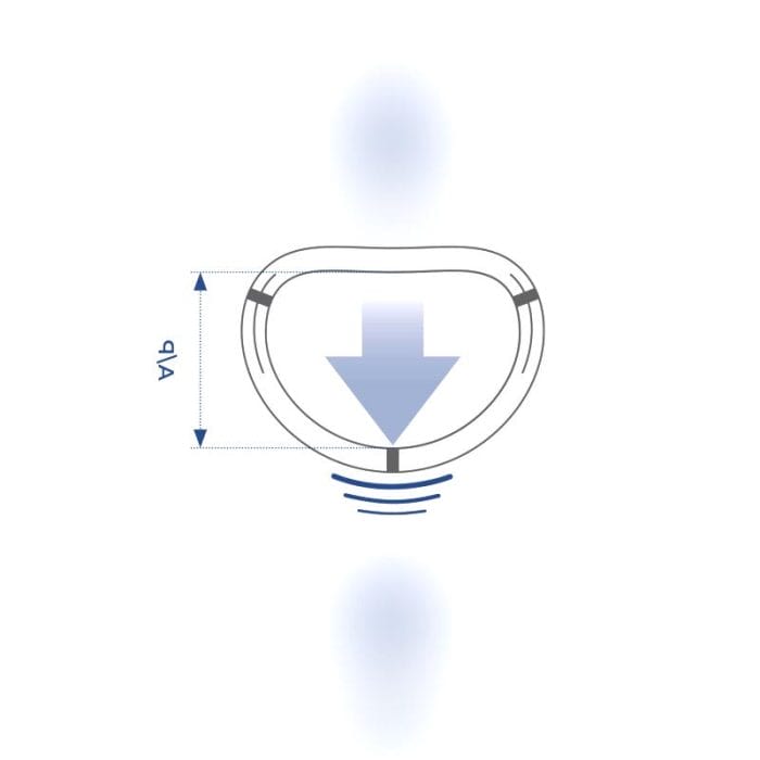 Mitral Annuloplasty Ring 1