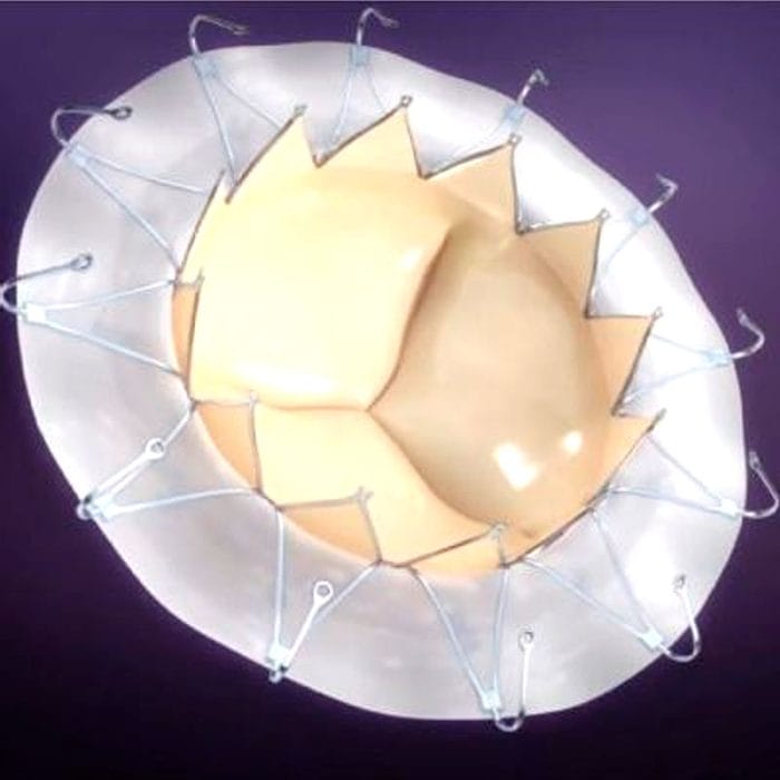 Mitral Valve Bioprosthesis