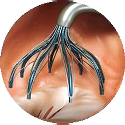 Mitral Valve Cardiac Restoration System 1