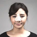 Nasal Splint