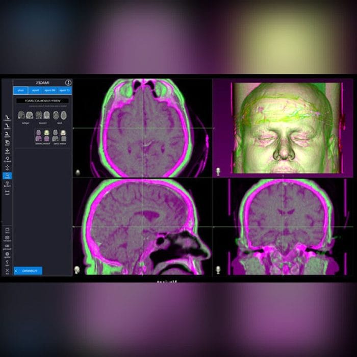 Neurosurgery Surgical Navigation System 3