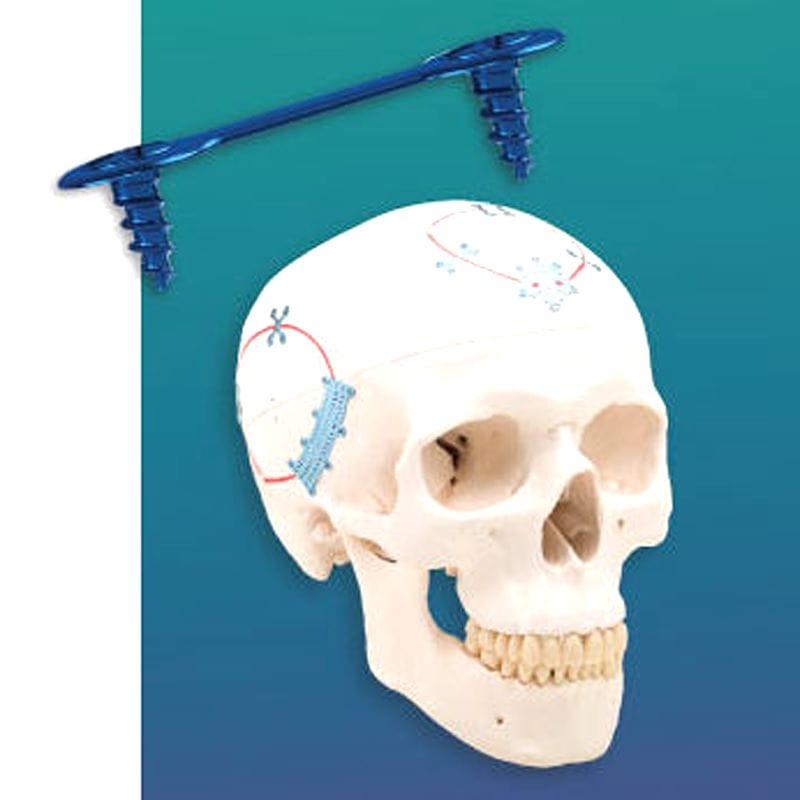 Non-Absorbable Cranial Fixation System