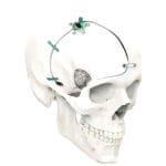 Non-Absorbable Cranial Fixation System