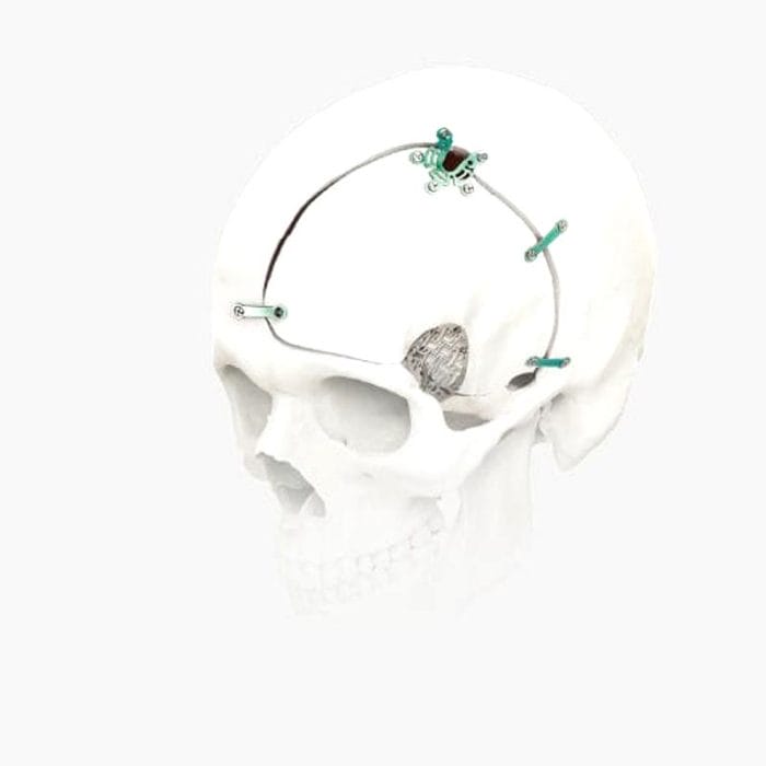 Non-Absorbable Cranial Fixation System 1