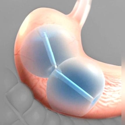 Non-Surgical Intragastric Balloon 1