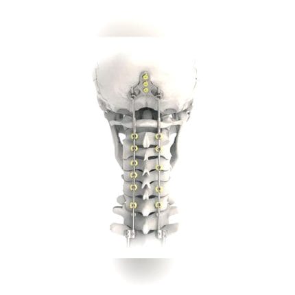 Occipito-Cervical Osteosynthesis Unit 1