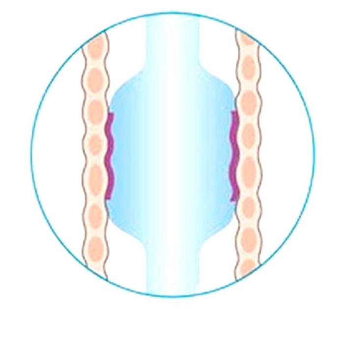 Oral And Nasal Endotracheal Tube 6