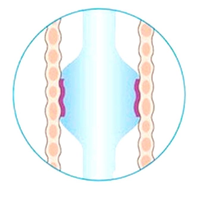 Oral And Nasal Endotracheal Tube 7