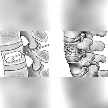 Orthopedic Surgery Bone Cement 1