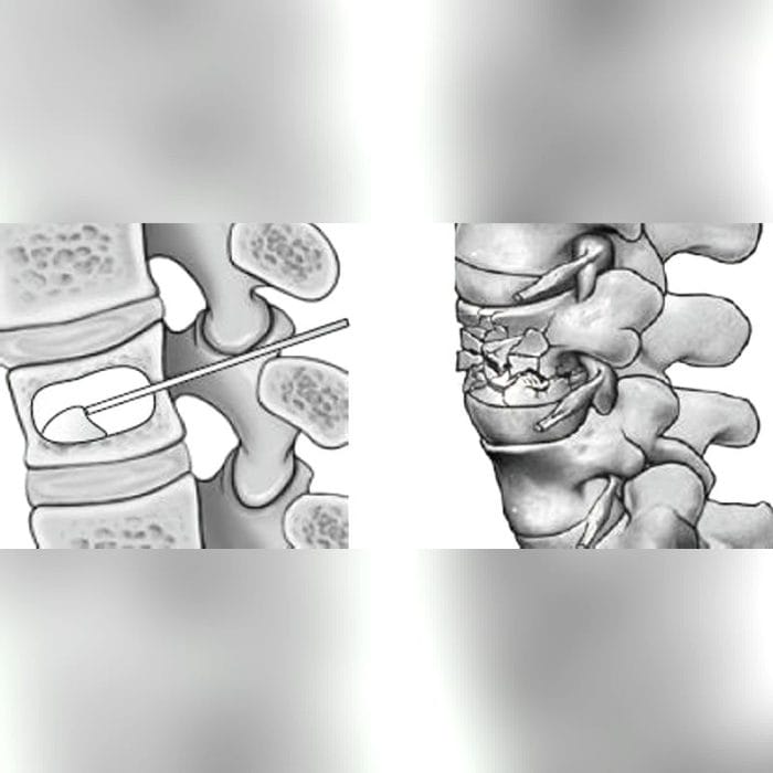 Orthopedic Surgery Bone Cement 1