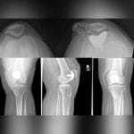 Patello-Femoral Prosthesis 3